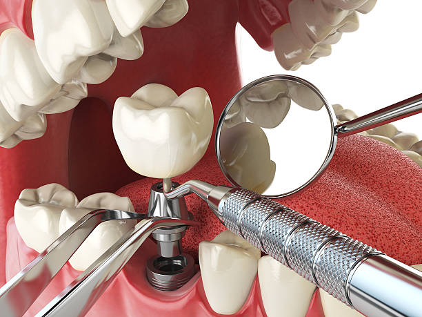 Best Emergency Wisdom Tooth Extraction in Delisle, MS